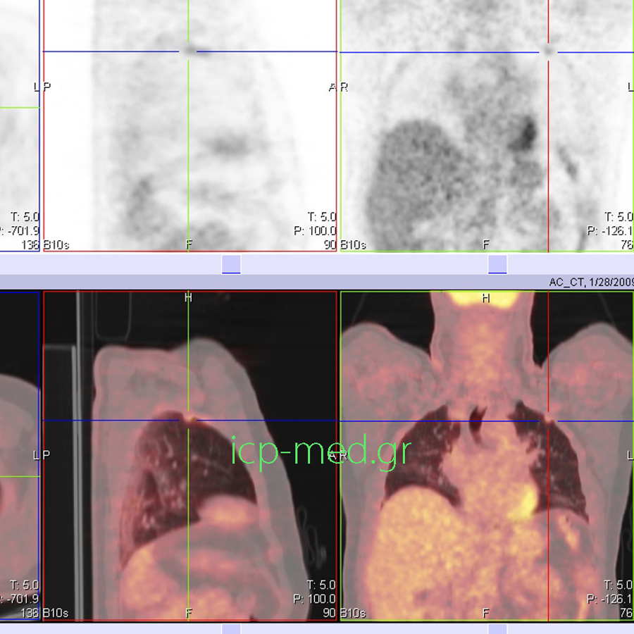 9. Προεγχειρητική PET/CT Μάζας στον πνευμονικό ΑΑΛ (μ.δ. 1,1 cm), Ύποπτης για Κακοήθεια (τελικώς: TBC)