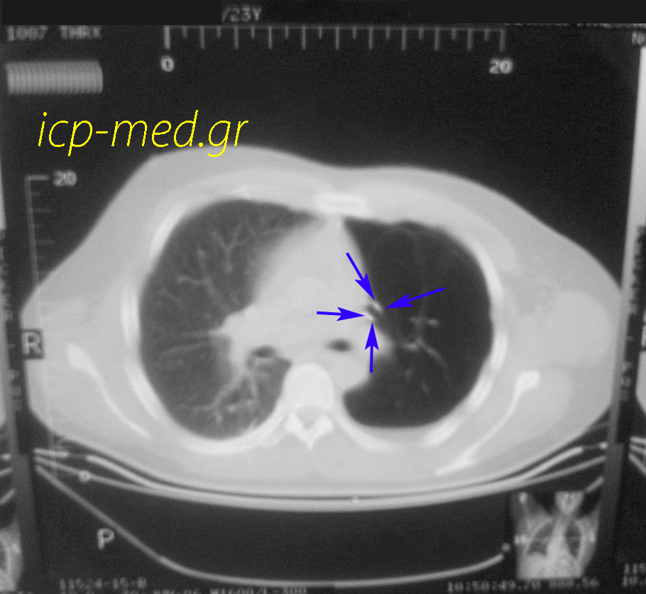 4. CT θώρακος: αγγειακή ερήμωση αριστερά (στένωση της αρ. πνευμονικής αρτηρίας) & Πνευμοθώρακα