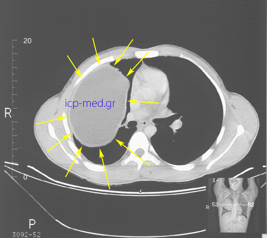 5. Προεχγ/κή CT: Γιγαντιαία Υδατίδα Κύστη (18 x 12 cm, ΚΙΤΡΙΝΑ βέλη) δεξιού πνεύμονος