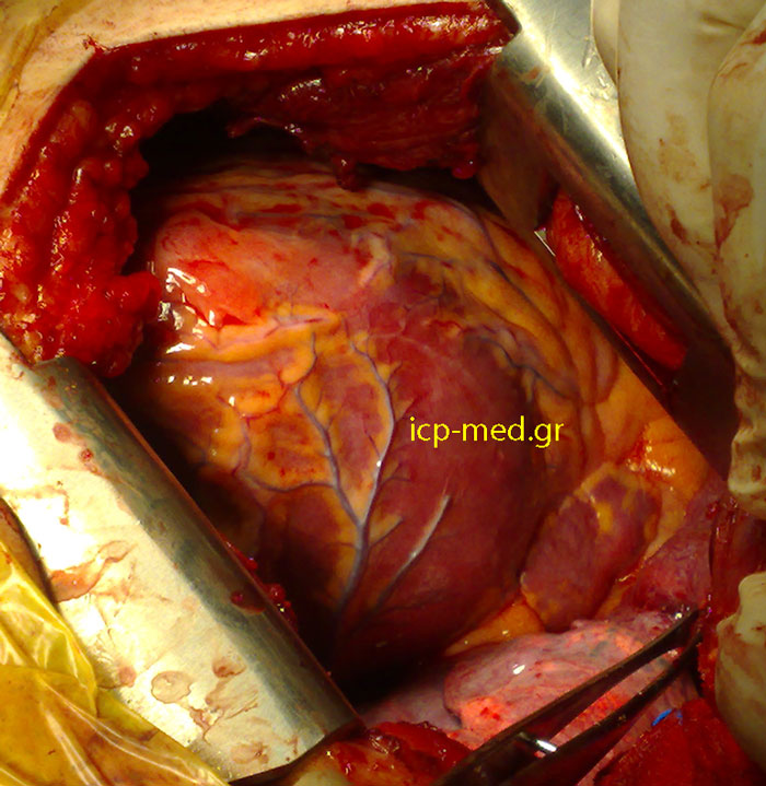 Διεγχειρητική φωτογραφία Αγενεσίας Περικαρδίου: διακρίνονται τα στεφανιαία αγγεία πάνω στο (γυμνό περικαρδίου) Μυοκάρδιο