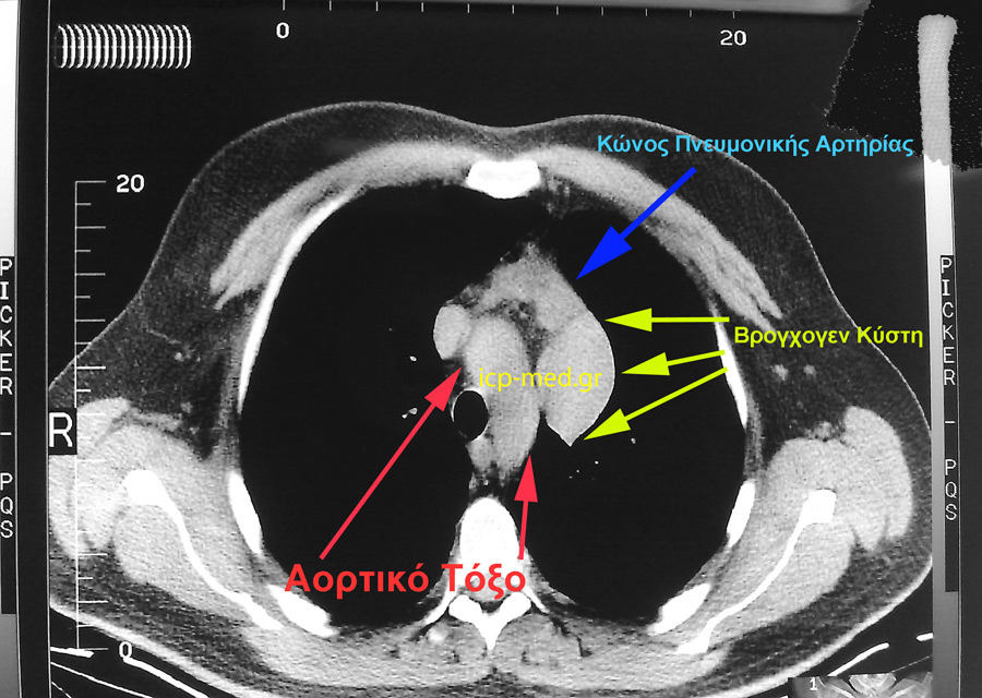 Προεγχειρητική CT του ασθενούς με Αγενεσία Περικαρδίου: η βρογχογενής κύστη Μεσοθωρακίου καταδεικνύεται από ΚΙΤΡΙΝΑ βέλη (Κώνος πνευμονικής αρτηρίας με ΜΠΛΕ. Αορτικό τόξο με ΕΡΥΘΡΑ)