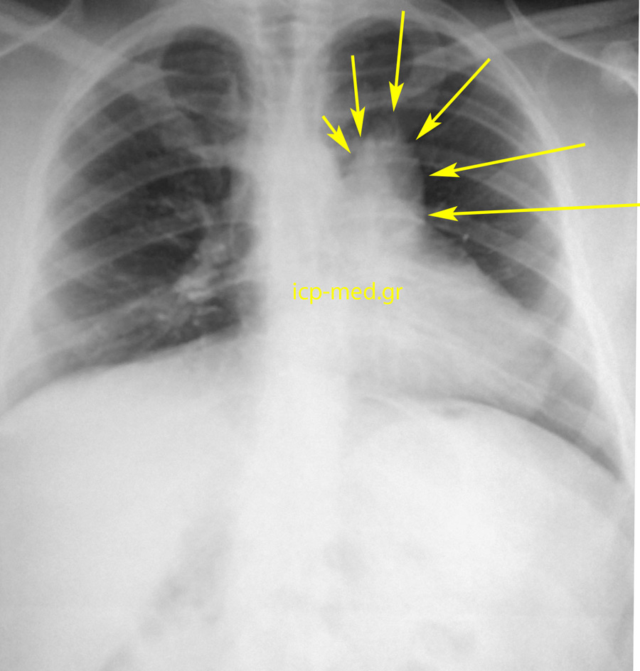 Preoperative CXR of the case with Agenesis of Pericardium: the bronchogenic cyst is shown by YELLOW arrows