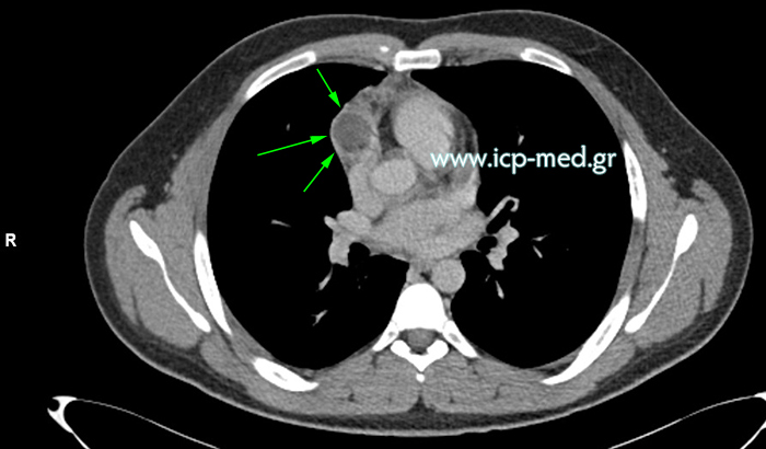Preoperative CT of mediastinal teratoma