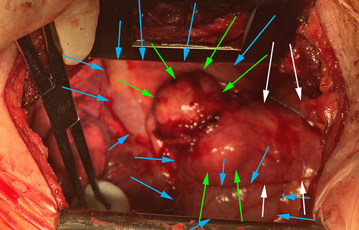 Intraoperative photograph of a mediastinal teratoma